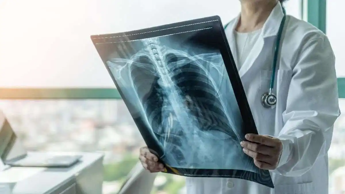Mikroplastik pada Penderita Kanker Paru-paru: Sebuah Temuan Mengkhawatirkan